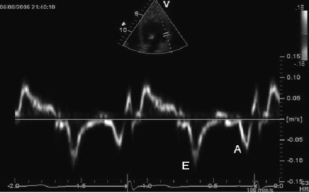 peak tissue Doppler velocity in early diastole and atrial contraction are shown. See the text for details.