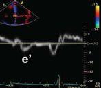 2000 E/e between 8 15 other echo indices should be used When using lateral or average
