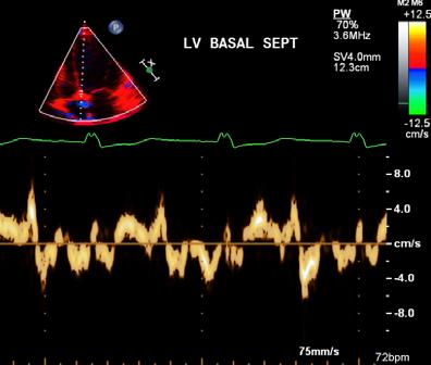 56 y old female with ACS/NSTEMI