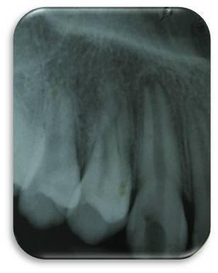 Figure 1. Preoperative radiograph showing tooth with an immature apex and periapical radiolucency.