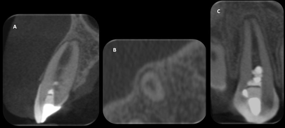 A CBCT scan (CareStream CS9300, SNAAP Imaging Centre, Ahmedabad, India) was taken at 13 th month recall to evaluate the outcome. (Fig. 4) Figure 3.