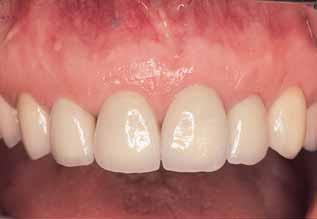Restorative Dental Treatment Collaboration between the restorative dentist and periodontal specialist is essential in the development of a final treatment plan to realize the fullest potential for