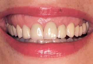 Teeth 17, 15, 14, 13, 12, 11, 21, 22, 23, 24, 25, 27, 37, 36, 35, 45 and 47 were restored with metal ceramic crowns.
