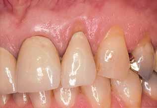 Class I Class II Class III Class IV Marginal recession that does not extend beyond the mucogingival junction. There is no loss of bone or soft tissue in the interdental area.
