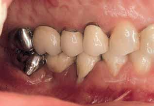 Figs. 3a e Intraoral appearance prior to the anti-infective therapy.