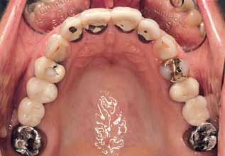 Teeth 14, 11 and 21 had been treated endodontically.