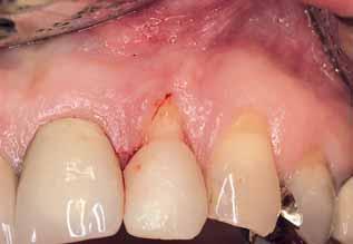 Subepithelial Connective Tissue Graft For the treatment of the recession at tooth 22, a subepithelial connective tissue graft was performed (Langer and Calagna, 1980).