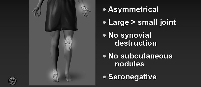 incidentally on Xrays Ankylosing spondylitis (AS) Insidious onset of low back