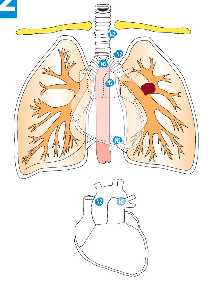 intrapulmonary nodes, including involvement by direct