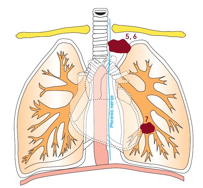 including superior sulcus tumours (3) -diaphragm (4)