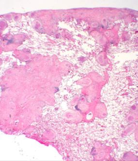 material, perigranuloma fibrosis, perigranuloma infiltrate Lung tissue away from the granulomas: