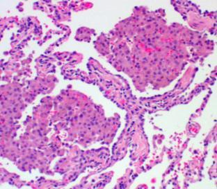 Alveolar Damage NSIP: HISTOLOGIC