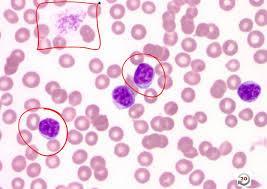 Peripheral blood smear Lymphocytosis Low platelets Size and shape of red blood cells Quantity