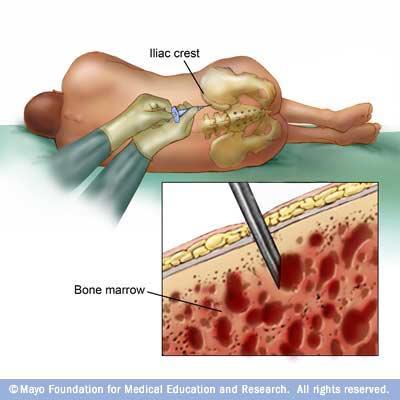Assessment of bone marrow