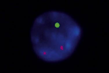 signal: deletion of a chromosome arm Normal MYC signal MYC