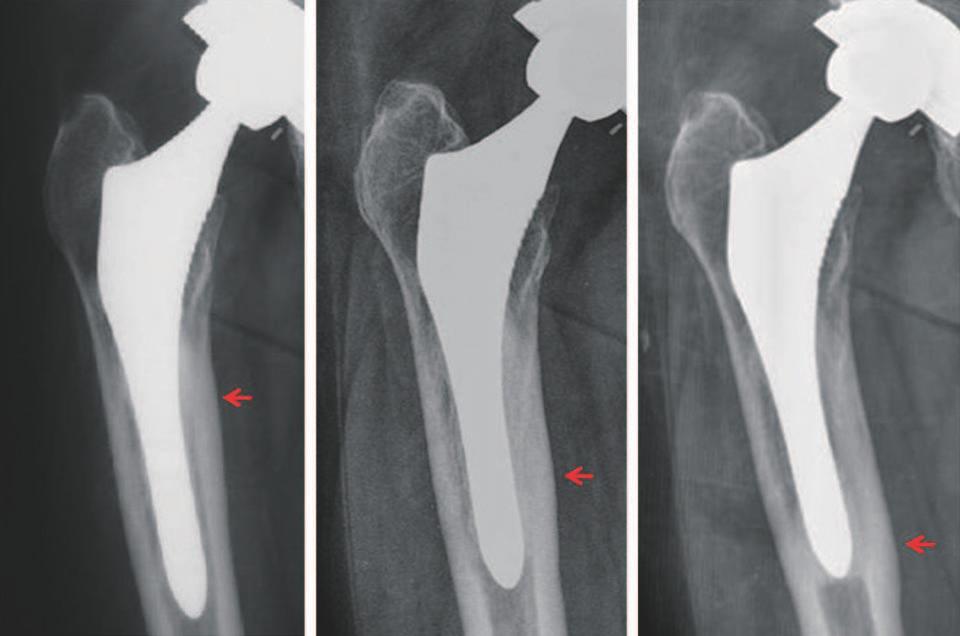 Young-Yool Chung et al. Effect of HA Coating on THA with HA-coated Anatomic Femoral Stem osteolysis was the cause in 14 cases (Fig. 3).
