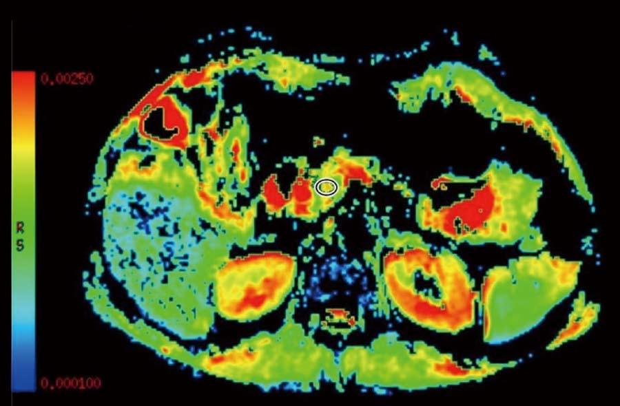 Hansen TM et al. Magnetic resonance imaging in chronic pancreatitis Table 1 Advantages of magnetic resonance imaging techniques Figure 3 Diffusion weighted imaging.