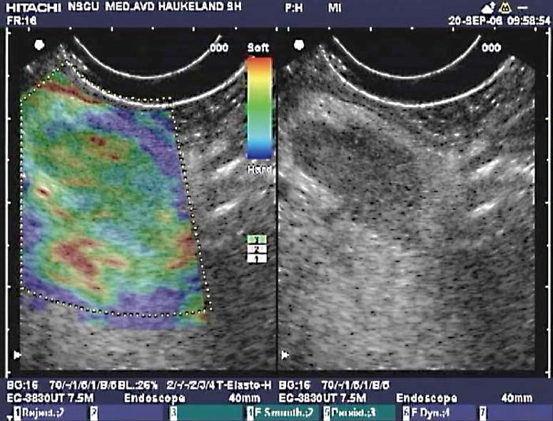 Dimcevski G et al. Modern ultrasonography in chronic pancreatitis Figure 6 Endoscopic ultrasonography B-mode sonogram and elastogram of lymph node in chronic pancreatitis.