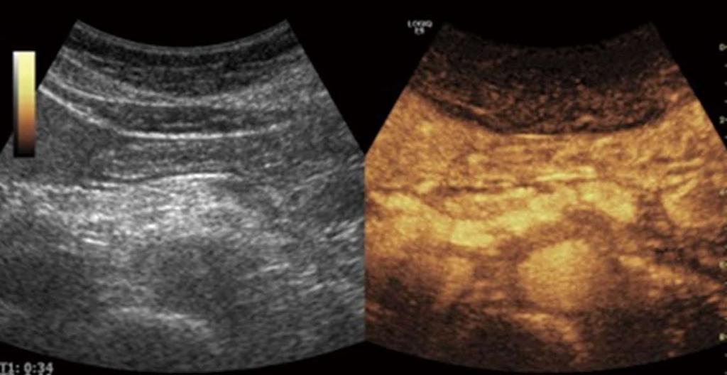 Dimcevski G et al. Modern ultrasonography in chronic pancreatitis Figure 8 An example of contrast enhanced ultrasound in advanced chronic pancreatitis.