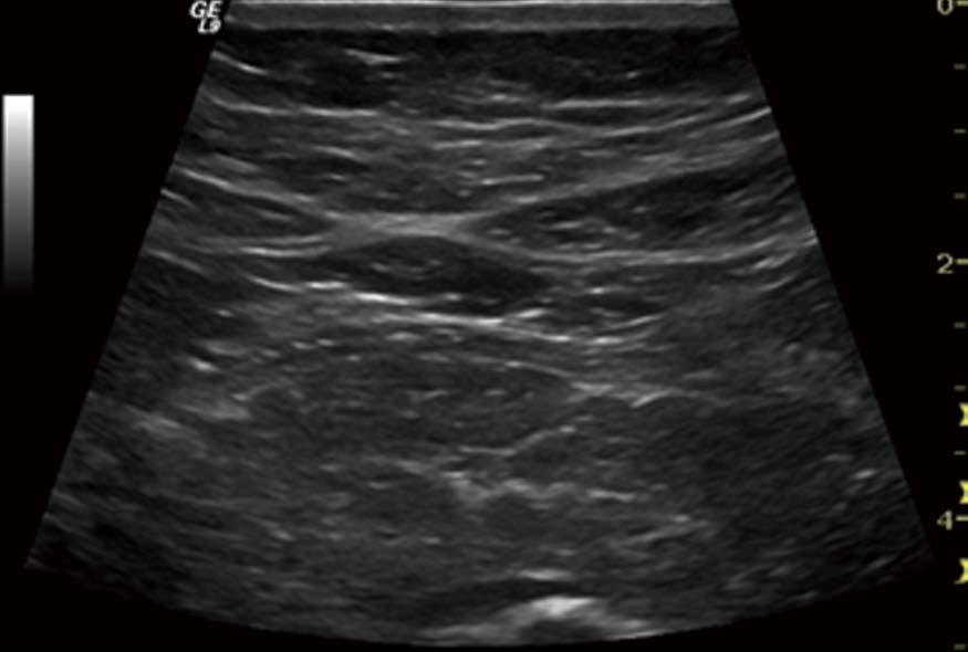 The elastogram shows predominantly soft (red) tissue with parts of green and yellow, indicating harder pancreatic tissue. Ho H L Corpus S Figure 10 Early chronic pancreatitis.