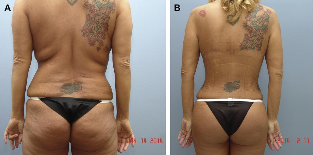 29 and 30 is concealed easily within the bra line. Fig. 32. (A) A 44-year-old woman who desired contouring to correct skin and subcutaneous fat changes with age.