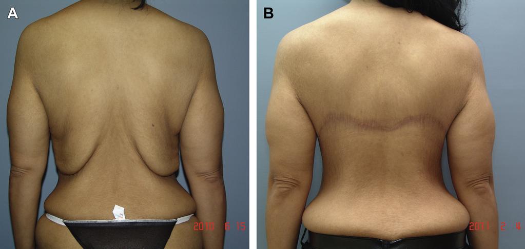 The bra line back lift achieved a complete correction of dramatic excess of skin and subcutaneous tissue in the flank and back. Her marking photographs can be seen in Figs. 1 15.