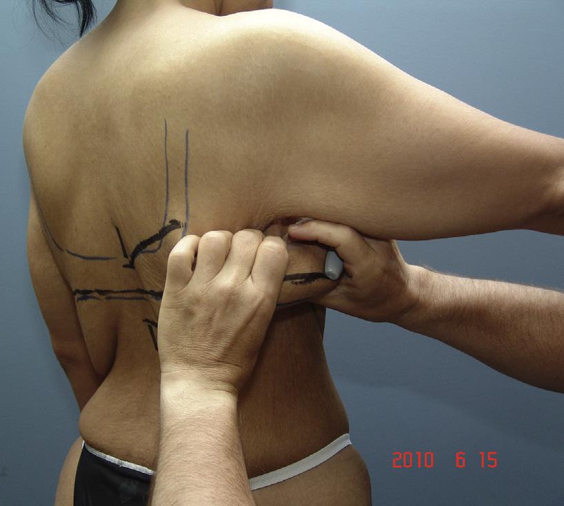 A standard photographic technique is used to record the entire lateral and upper back 224 Q9 condition.