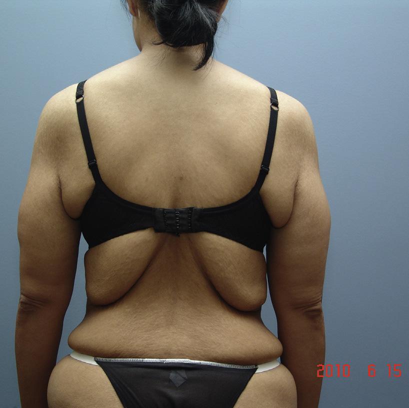 The boundary of the patients ideal scar position is marked to fall within the outlined margins of the bra or bathing suit top of choice (Figs. 5 and 6).