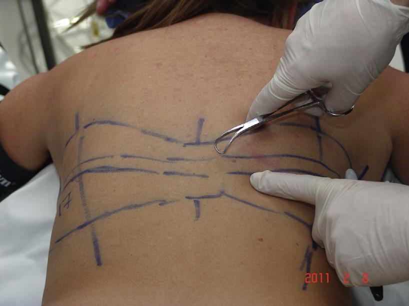 As seen in this photograph, the widest margins of resection will fall within the area of the posterior axillary line, the most distant from the midline zone of adherence.