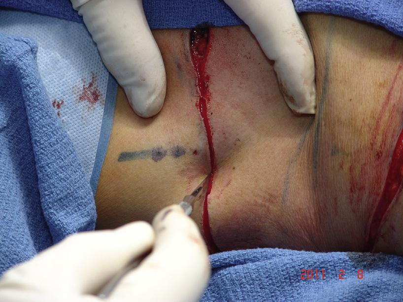 Note how the tattooing is performed outside of the resection pattern so that they may be seen at the