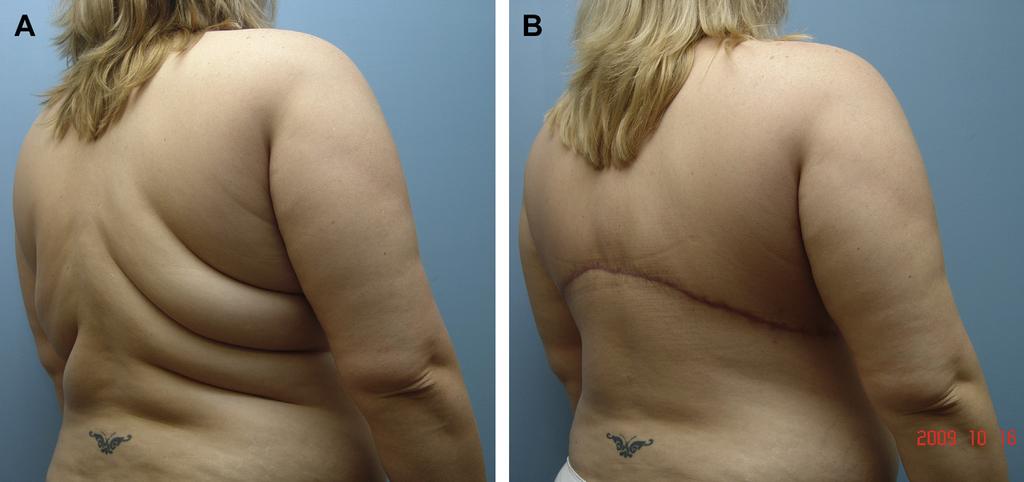 (B) After bra line back lift, a smooth contour is achieved. case in less than 5% of cases.