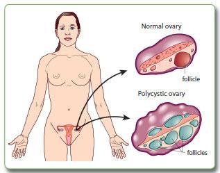 Information for patients Polycystic ovary syndrome (PCOS) What is polycystic ovary syndrome?
