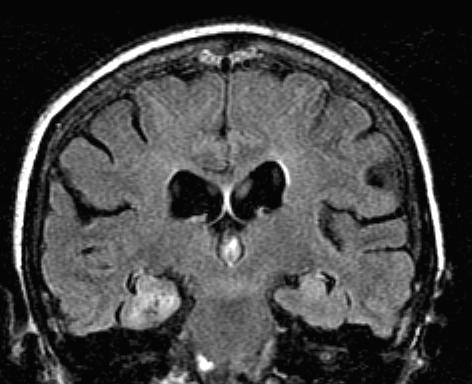 PARTIAL EPILEPSY lesional epileptic syndrome Primary brain tumor ganglioglioma,