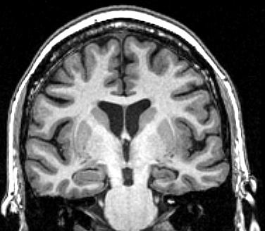 PARTIAL EPILEPSY medial temporal lobe epilepsy