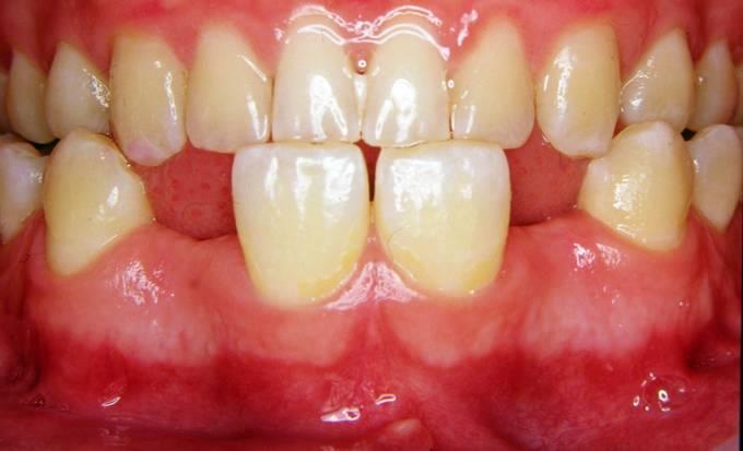 Treatment strategies: 1. Fixed partial dentures (Bridges). 2.