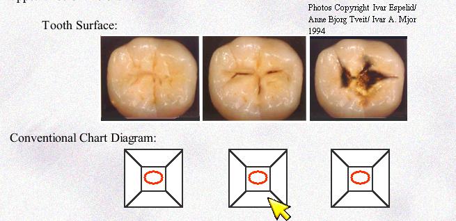 Limitations of Conventional Caries Representation Tooth Surface Different
