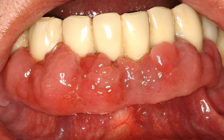 Prevalence of gingival overgrowth induced