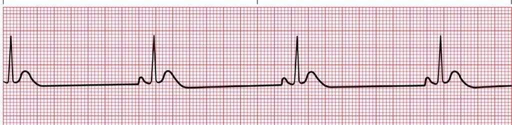 Bradycardia 1. Oxygen First 2. Begin CPR if HR is < 60 with signs of poor perfusion 3.