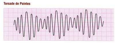 Torsades de Pointes 1. Magnesium 25-50mg/kg over 10 minutes Synchronized Cardioversion (For Unstable Patients).5-1J/kg for first dose and increase 2J/kg if the initial dose is ineffective.** Steps: 1.