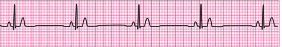 Pulseless Electrical Activity (PEA) or Asystole Treatment: 1. Rhythm and Pulse Check 2. CPR 2 Minutes 3. Rhythm and Pulse Check (if no change continue to #4) 4. CPR 2 Minutes and Epi.01mg/kg 5.
