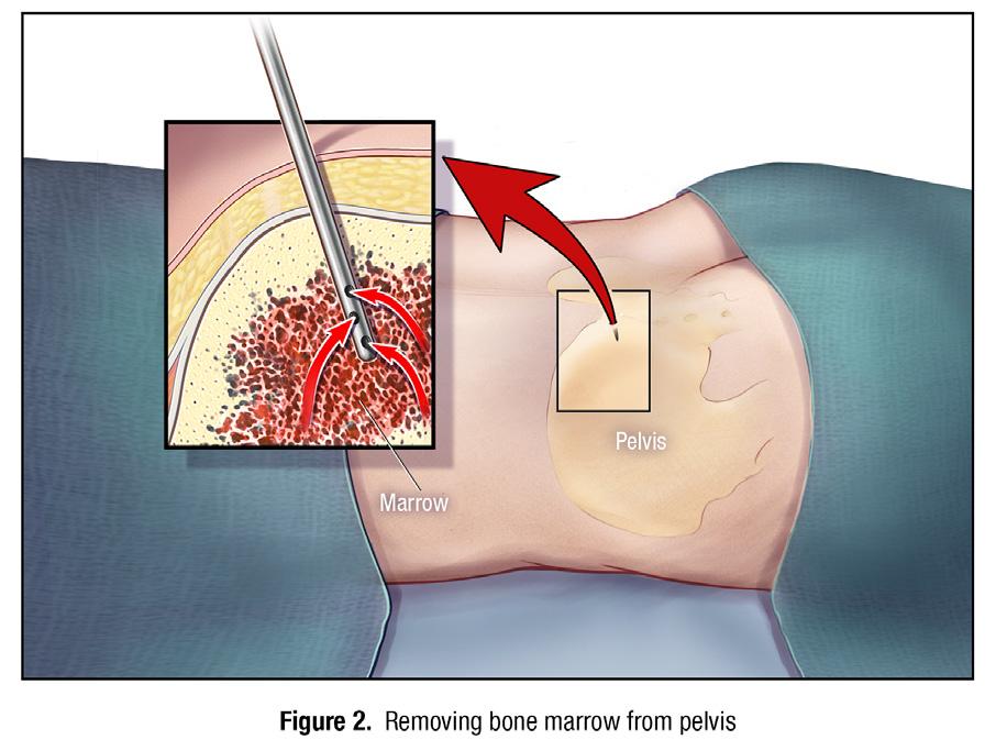 Page 7 of 16 How is BMAC made? Bone marrow is most commonly taken from the back of your pelvic bone. See Figure 2. While you lie on your side or your stomach, a member of your health care team: 1.