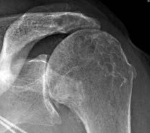 Superior Capsular Reconstruction Biomechanical Studies have shown the importance of the Superior Capsule in preventing superior migration of the humeral head Replacing the superior capsule can