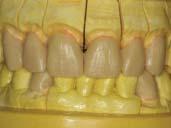 This impression was then carefully seated on the model of the prepared teeth and wax was injected into the impression of the provisional restorations to achieve