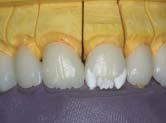 Figures 17A and 17B The incisal effect porcelains were applied.
