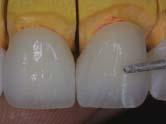 To ensure preservation of the already achieved incisal form and position, a silicone matrix was