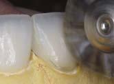 These contours can be modified and smoothed after cementation when the restoration is of much higher strength.