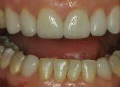 While leaving the teeth moist, bonding agent (Single Bond, 3M ESPE) was placed and lightly air-dried. Both the facial and lingual surface were lightcured for 20 seconds.