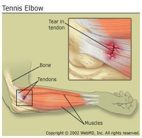 Common Injuries Lateral epicondylitis Tennis Elbow Mechanism of Injury Signs and Symptoms Treatment Prevention Strategies Repetitive extension of the wrist.