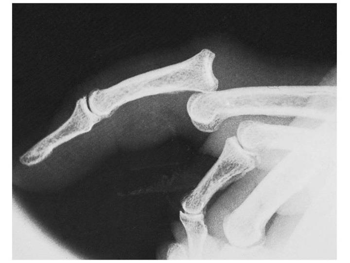 Common Injuries Interphalangeal Dislocation Mechanism of Injury Blow to the tip of the finger.
