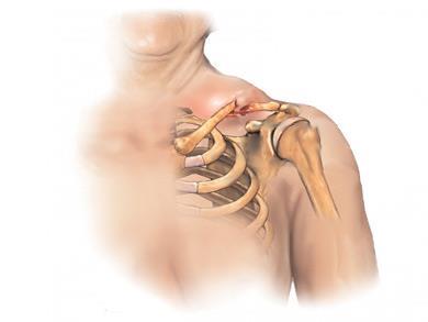 Common Injuries Clavicle Fracture Mechanism of Injury 1.